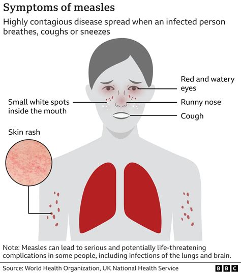 MMR Vaccine Reactions