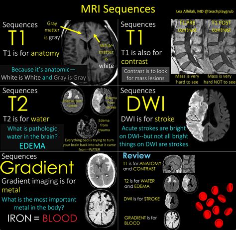 MRI Brain Scan Basics