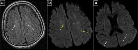 MRI Brain Scan Follow-Up