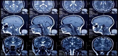 MRI Brain Screening Tips