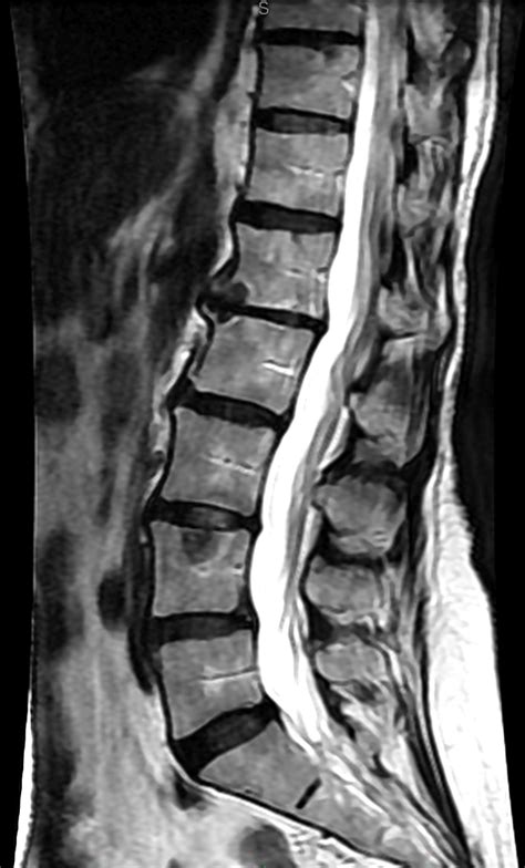MRI of Lumbar Spine