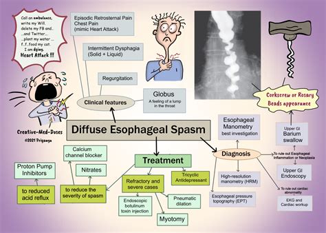 Managing Esophageal Spasms