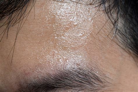 Managing Hyperhidrosis in Daily Life