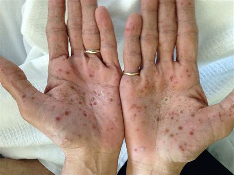 Managing Rashes