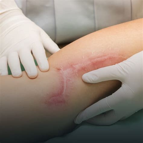 Managing Boil Scars