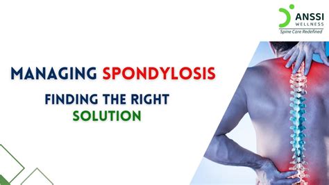 Managing Spondylosis Symptoms