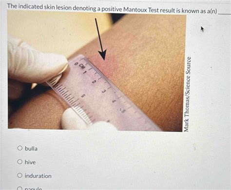 Mantoux Test Results