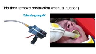 Manual Removal of Obstruction