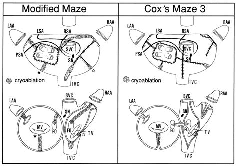 Maze Surgery for Atrial Fibrillation