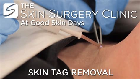 Medical Procedures for Skin Tag Removal
