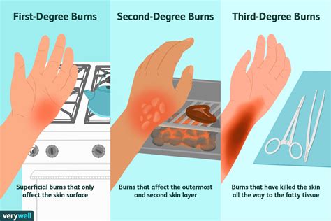 Medical Treatment For Severe Burns