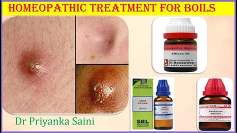 Medical Treatments for Boils