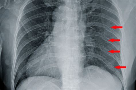 Medical Treatments for Broken Ribs