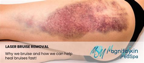 Medical Treatments for Bruising