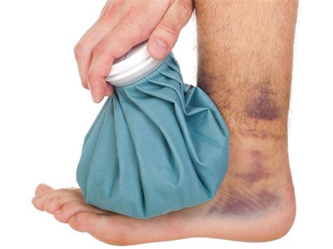 Medical Treatments for Bruising