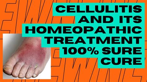 Medical Treatments for Cellulitis