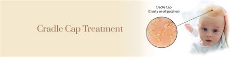 Medical Treatments for Cradle Cap