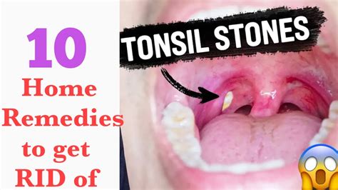 Medical Treatments for Tonsil Stones