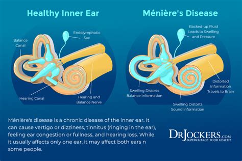 Meniere's Disease Causes