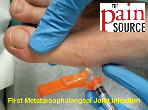 Metatarsal Phalangeal Joint Injections