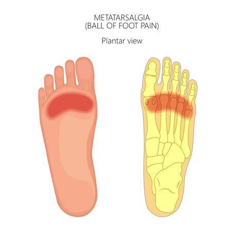 Metatarsal Phalangeal Joint Pain