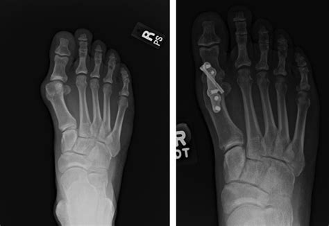 Metatarsal Phalangeal Joint Surgery