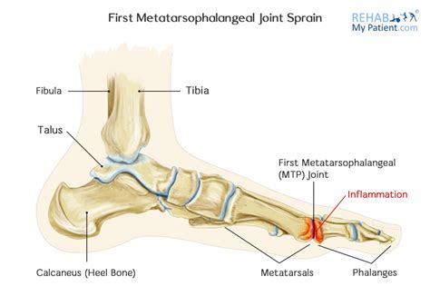 Metatarsal Phalangeal Joint Treatment
