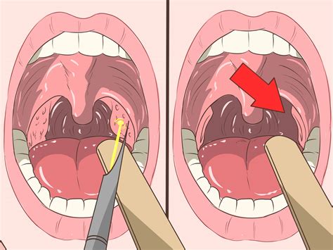 Methods for Removing Tonsilloliths