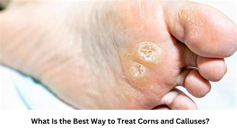 Methods to Fade Calluses