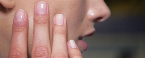 Nail Detachment Causes