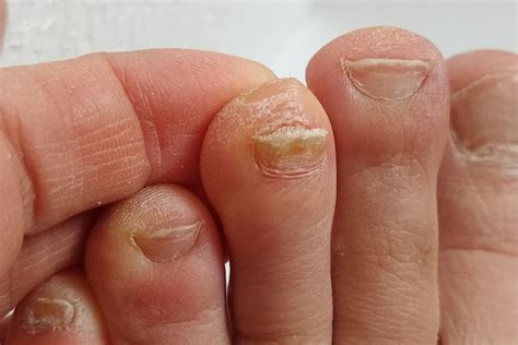 Nail Fungus Treatment