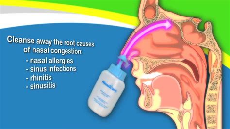 Nasal Irrigation Precautions