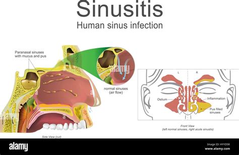 Nasal Mucus Plug Complications