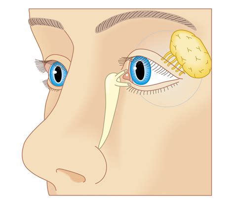 Nasolacrimal Duct Swelling