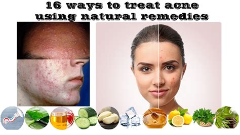 Natural Acne Treatments