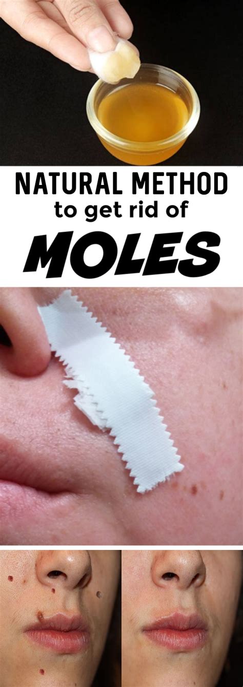 Natural Methods For Removing Moles