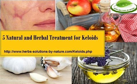 Natural Remedies for Keloids