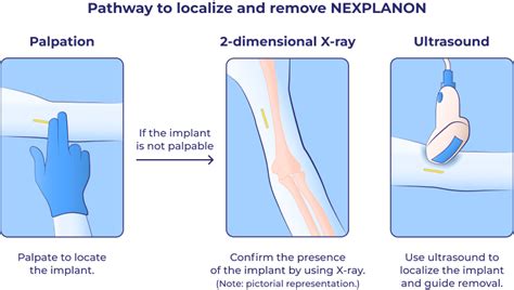 Nexplanon Insertion Removal