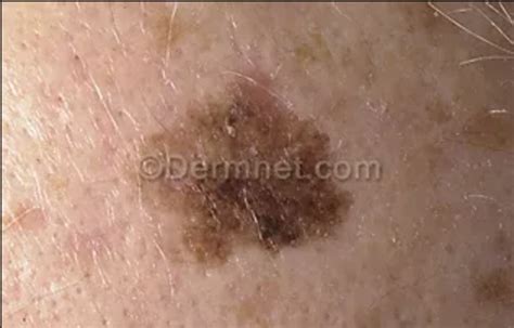 Non-Cancerous Conditions and CA125