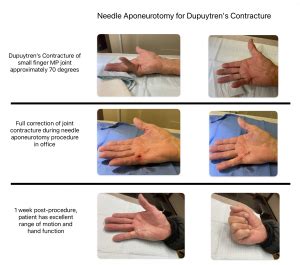 Non-surgical treatment options for Dupuytren's contracture