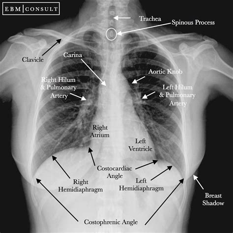 Normal Chest X-Ray Image