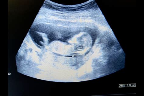 Nuchal Translucency Scan: Frequently Asked Questions