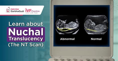 Nuchal Translucency Scan and Pregnancy Outcomes
