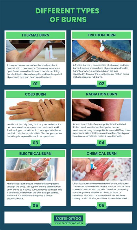 Ointment Types For Burns