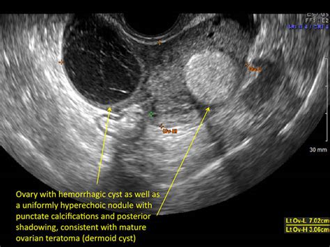 Ovarian Hemorrhagic Cyst