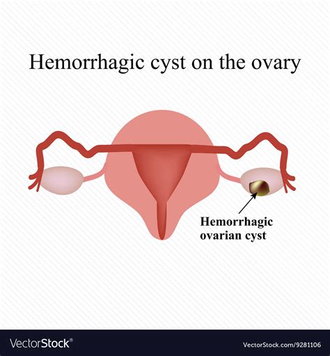Ovarian Hemorrhagic Cyst Types