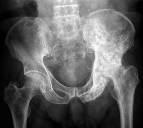 Paget's Disease of the Breast