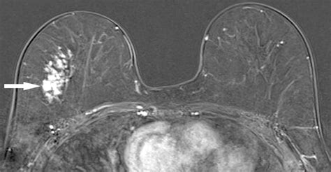 Paget's Disease of the Breast