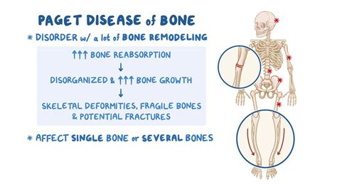 Paget's Disease Symptoms