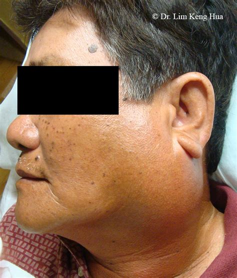 Symptoms of Parotid Gland Swelling